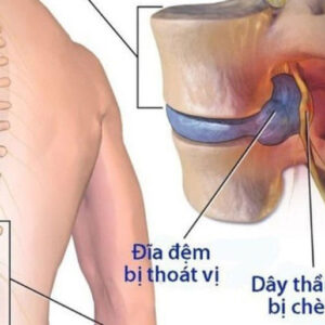 Cải thiện tình trạng thoát vị đĩa đệm nhờ phương pháp Chiropractic
