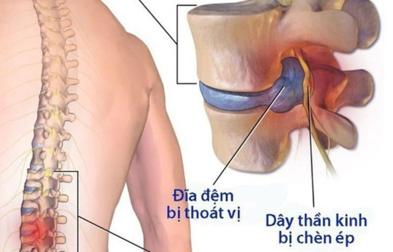 Cải thiện tình trạng thoát vị đĩa đệm nhờ phương pháp Chiropractic