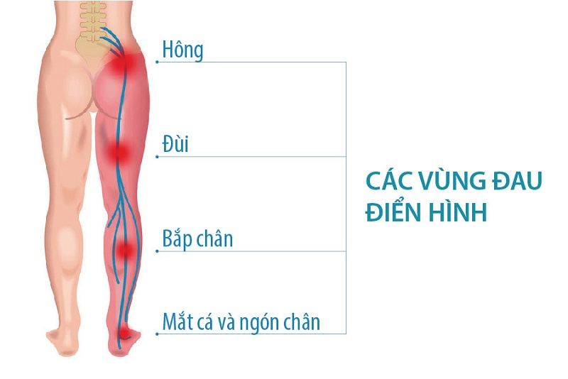 Chữa đau thần kinh toạ Trung Kính