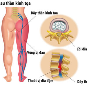 Chữa đau thần kinh toạ Trung Kính