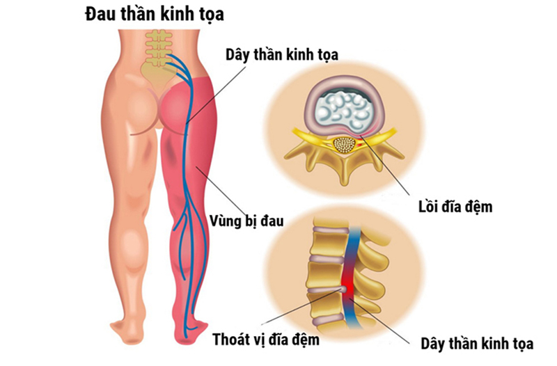 Chữa đau thần kinh toạ Trung Kính