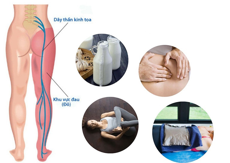 Chữa đau thần kinh toạ Trung Kính