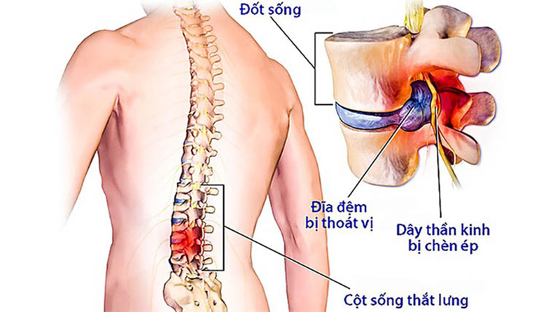 Chữa thoát vị đĩa đệm Trung Kính