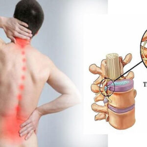 Địa chỉ chữa thoát vị đĩa đệm Trung Kính