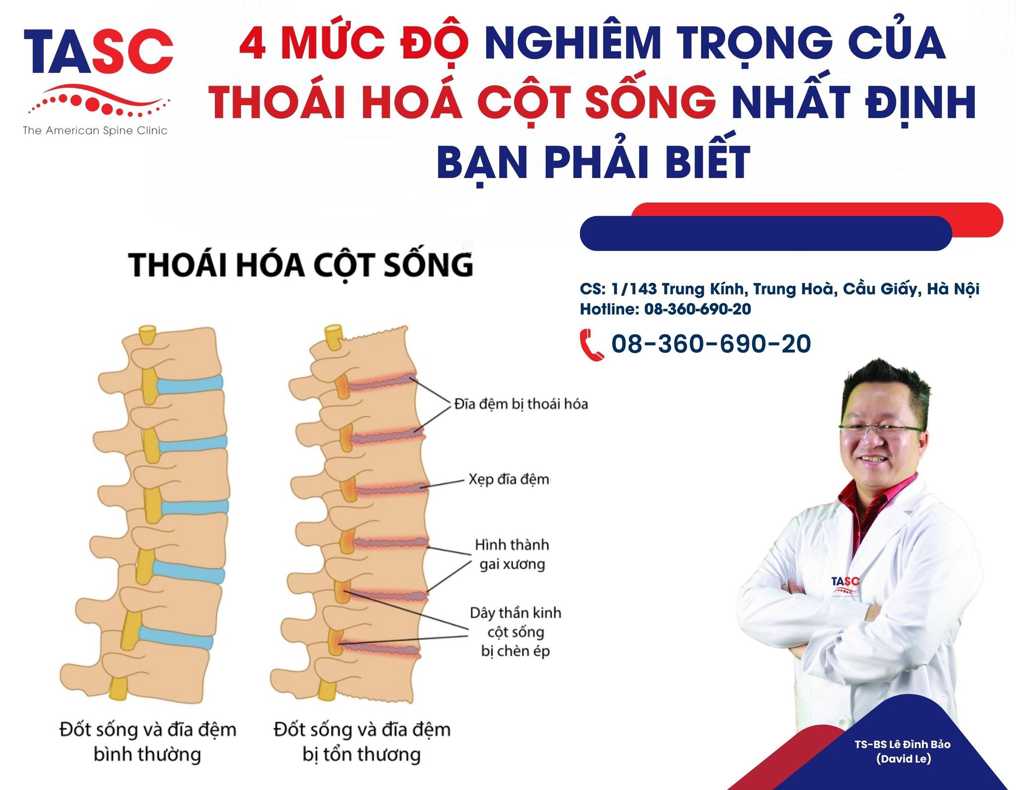 Thoát vị thoái hoá là gì? Chữa bằng cách nào?