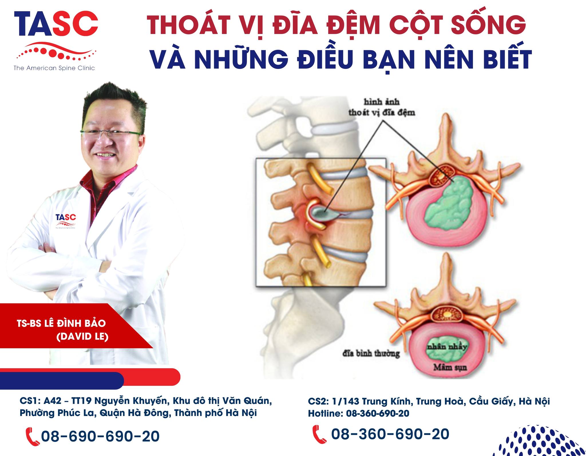 Thoát vị thoái hoá là gì? Chữa bằng cách nào?