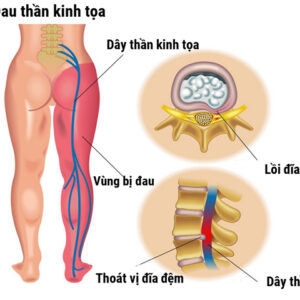 chữa đau thần kinh tọa Trung Kính