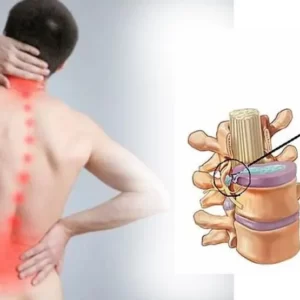 Gợi ý những phương pháp chữa thoát vị đĩa đệm Trung Kính hiệu quả nhất