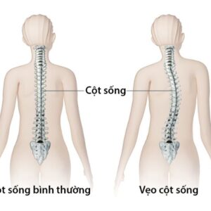 Phương pháp chiropractic có được áp dụng để chữa cong vẹo cột sống Cầu Giấy?